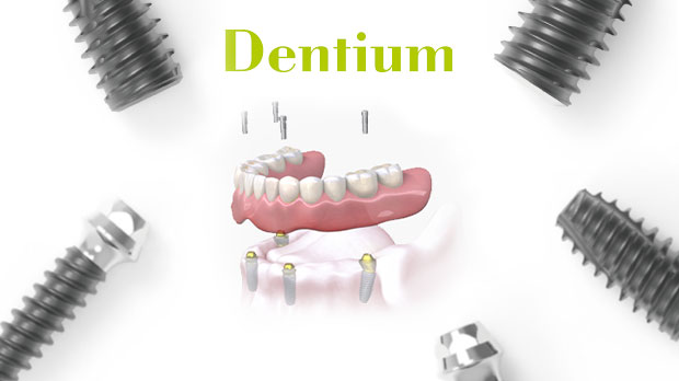 Импланты Dentium все на 6 имплантах решение для полной адентии методом Full-Arch и Large Bridge