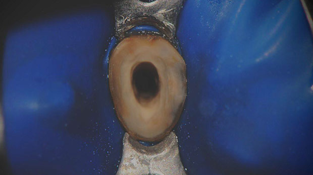 Эндодонтическое перелечивание зубов имеет свои особенности