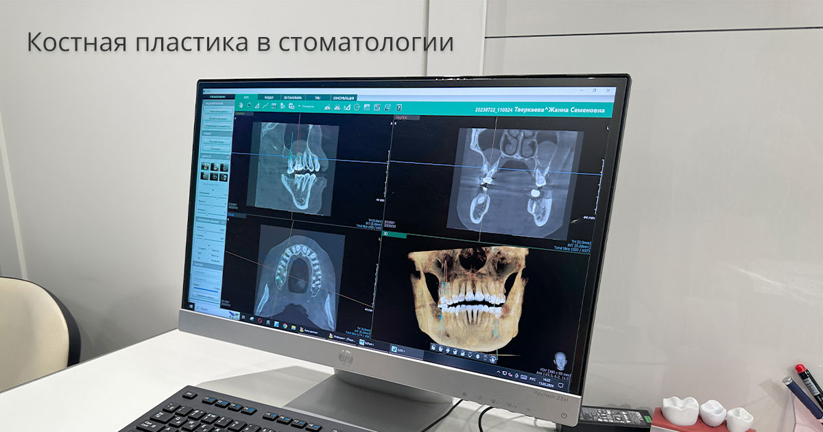 Костная пластика: методы проведения и возможные альтернативы