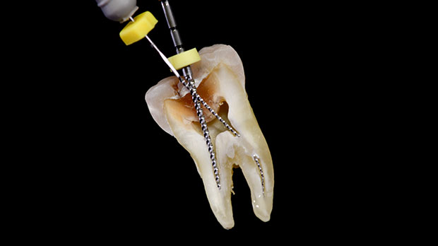Перелечивание каналов зуба или повторное эндодонтическое лечение