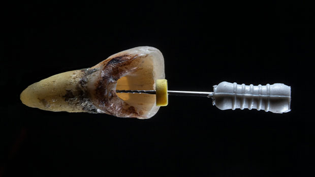 Показания к лечению каналов зуба