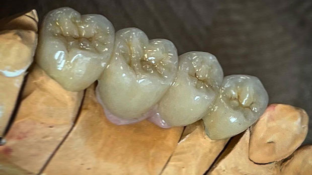Виды зубных мостов Мостовидные протезы из керамики E.max
