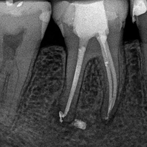 Возможные осложнения после лечения каналов зуба
