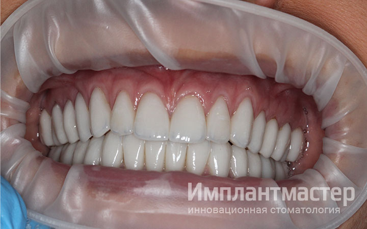 Фото пример совершенной эстетик зубов после протезирования винирами и коронками E-Max фото до после