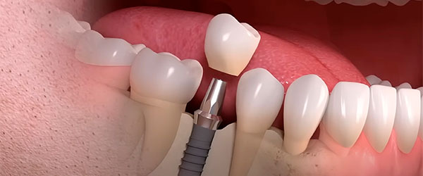 Имплантация зубов услуги в стоматологии Имплантмастер