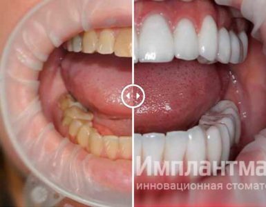 Комплексное и мастерское лечение в стоматологии имплантация с протезированием винирами и коронками E-Max фото до после пример