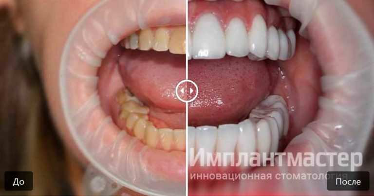 Комплексное и мастерское лечение в стоматологии имплантация с протезированием винирами и коронками E-Max фото до после пример