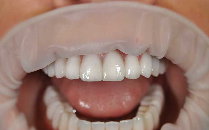 Комплексное и мастерское лечение в стоматологии имплантация с протезированием винирами и коронками E-Max фото пример после 2