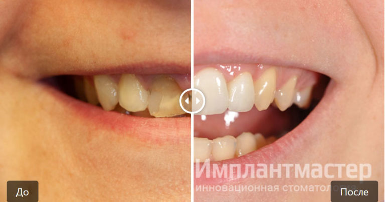 Эстетическая реставрация передних верхних зубов коронками и винирами E-Max фото до после