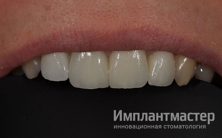 Эстетическая реставрация передних верхних зубов коронками и винирами E-Max фото после