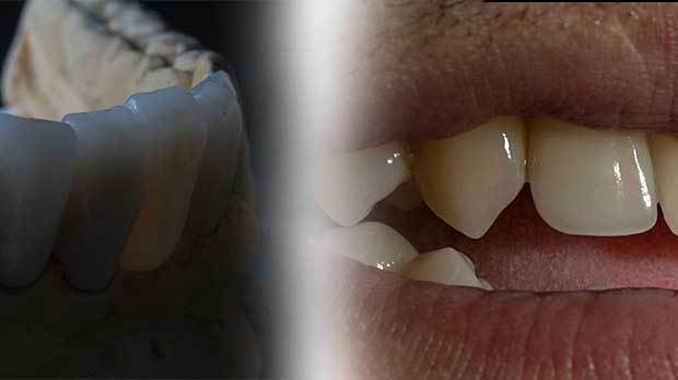 Керамические или золотые коронки на зубы выбрать?