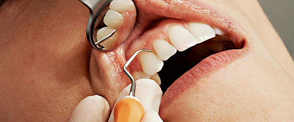 Лечение дёсен услуги в стоматологии Имплантмастер