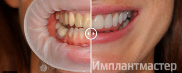 Протезирование верхних зубов поставлен постоянный протез виниры e.max и коронки e.max до после