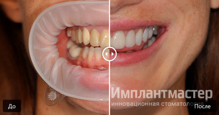 Протезирование верхних зубов поставлен постоянный протез виниры e.max и коронки e.max до после