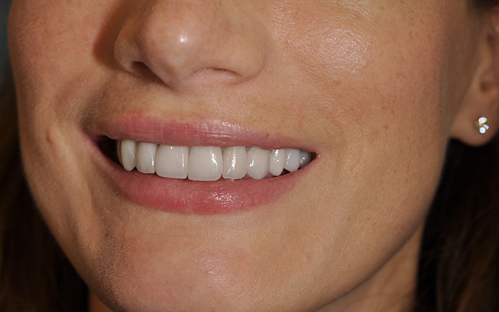 Протезирование верхних зубов поставлен постоянный протез виниры e.max и коронки e.max после