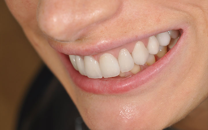 Протезирование верхних зубов поставлен постоянный протез виниры e.max и коронки e.max после фото