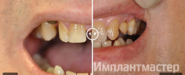 Протезирование винирами чтобы убрать щель между зубами до после фото