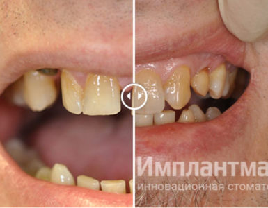 Протезирование винирами чтобы убрать щель между зубами до после фото