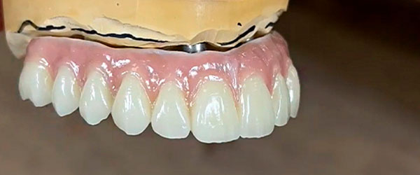 Протезирование зубов услуги в стоматологии Имплантмастер