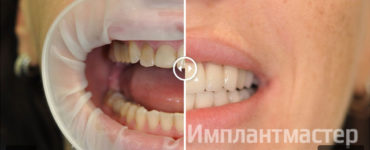Работа по протезированию и реставрации зубов винирами и коронками E-Max фото до после