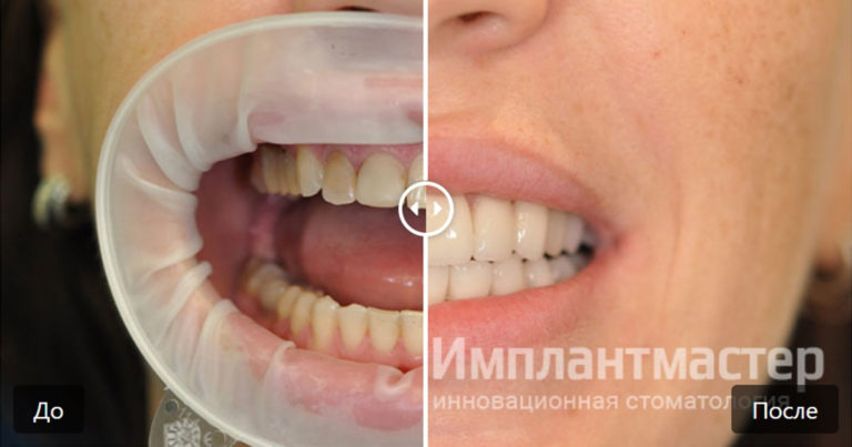 Работа по протезированию и реставрации зубов винирами и коронками E-Max фото до после