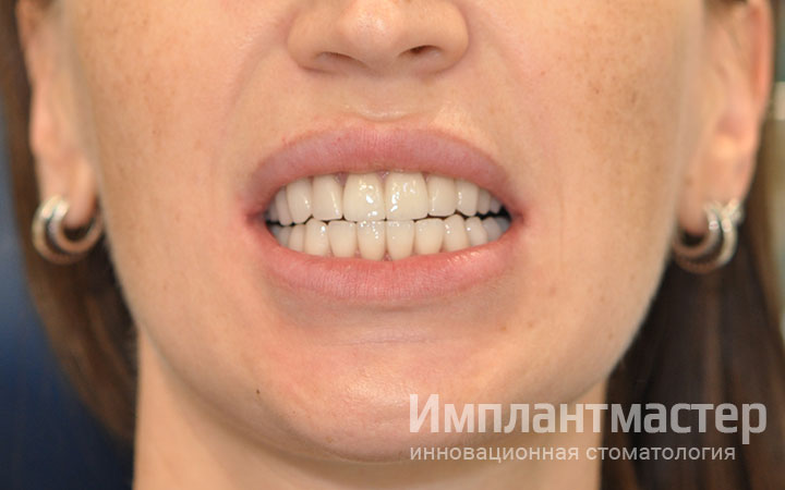 Работа по протезированию и реставрации зубов винирами и коронками E-Max фото