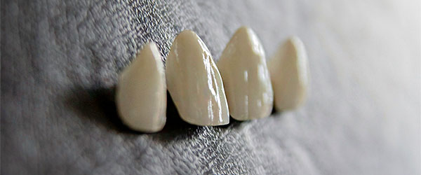Установка виниров услуги в стоматологии Имплантмастер