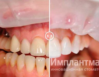 Замена старых коронок и виниров на новые из E-Max в верхнем зубном ряду фото пример до после