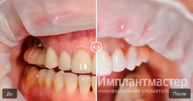 Замена старых коронок и виниров на новые из E-Max в верхнем зубном ряду фото пример до после