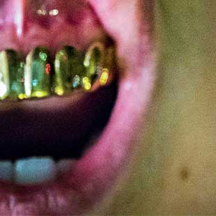 Золотые коронки на зубы золотые зубы, сколько стоит, поставить цена за 1 зуб, протезирование