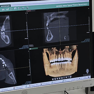 Что лучше рентген зубов или КТ?