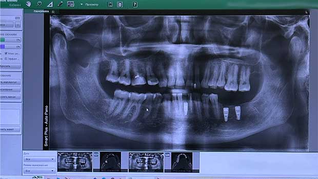 Что такое Ортопантомограмма, панорамный снимок зубов, ОПТГ зубов?