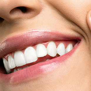 Что такое виниры на рефракторе в стоматологии?