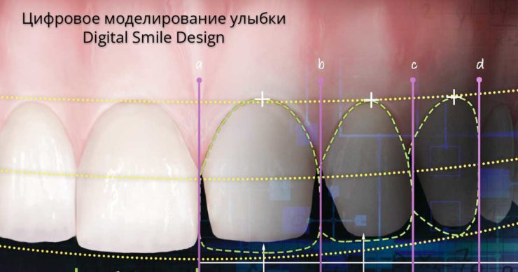 Цифровое моделирование улыбки — Digital Smile Design