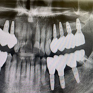 Для чего рентген в стоматологии