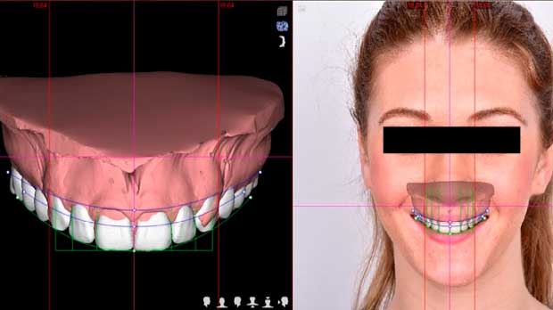 Достоинства и особенности моделирования улыбки в Digital Smile Design