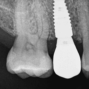 Имплантация зубов протокол GBT гигиена