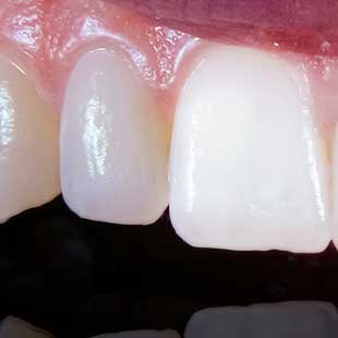 Компониры на зубы [что это в стоматологии, цена, отзывы и отличия от виниров]