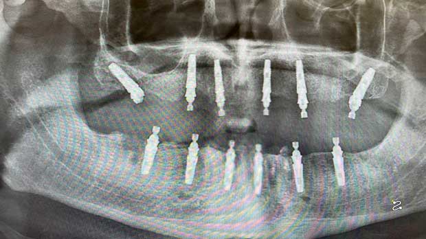 Ортопантомограмма, панорамный снимок зубов, ОПТГ при имплантации и протезирование зубов