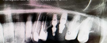 Панорамный снимок зубов или ОПТГ