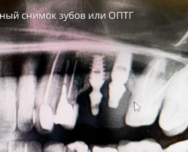 Панорамный снимок зубов или ОПТГ