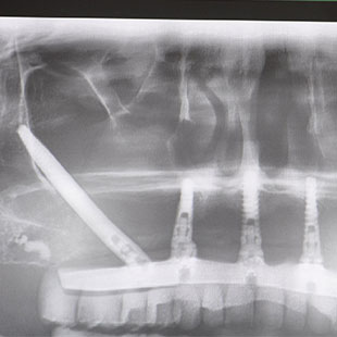 Почему нельзя откладывать лечение в стоматологии?