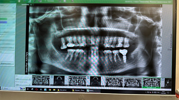 Рентген нижней и верхней челюсти в стоматологии Москвы