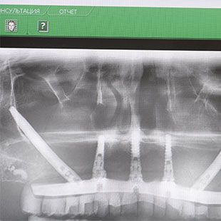 Рентген зубов и рентген челюсти в стоматологии