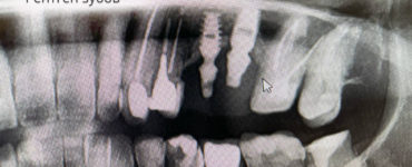 Рентген зубов рентген челюсти в стоматологии цена в Москве