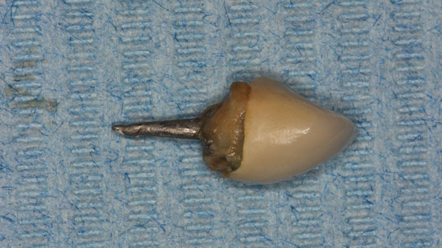 Виды которых бывает микропротезирование зубов Штифты