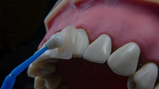 Виниры на зубы — что это такое?