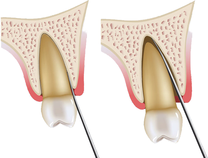Атравматичное удаление зубов
