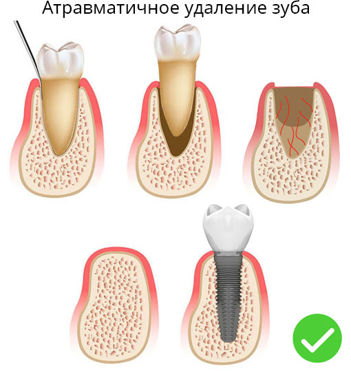 Атравматичное удаление зубов