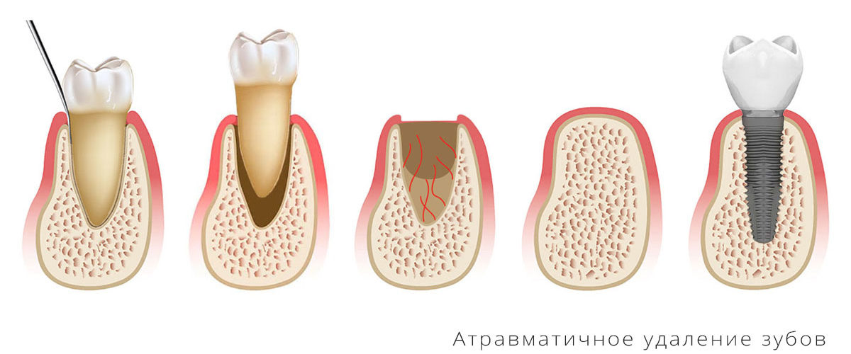 Атравматичное удаление зубов